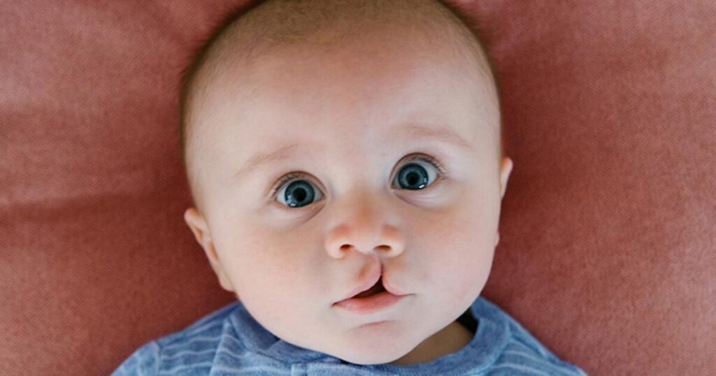 Cleft Palate